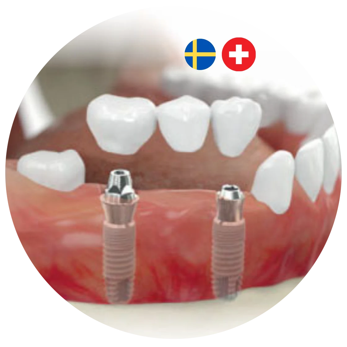 dental implant
