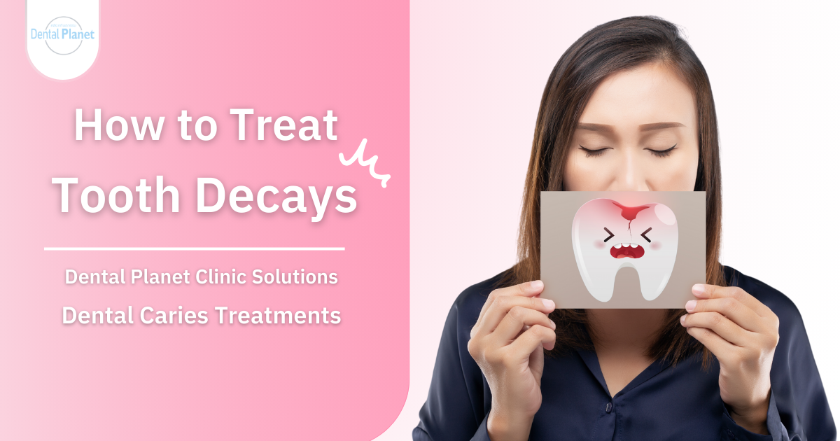 tooth decay treatments