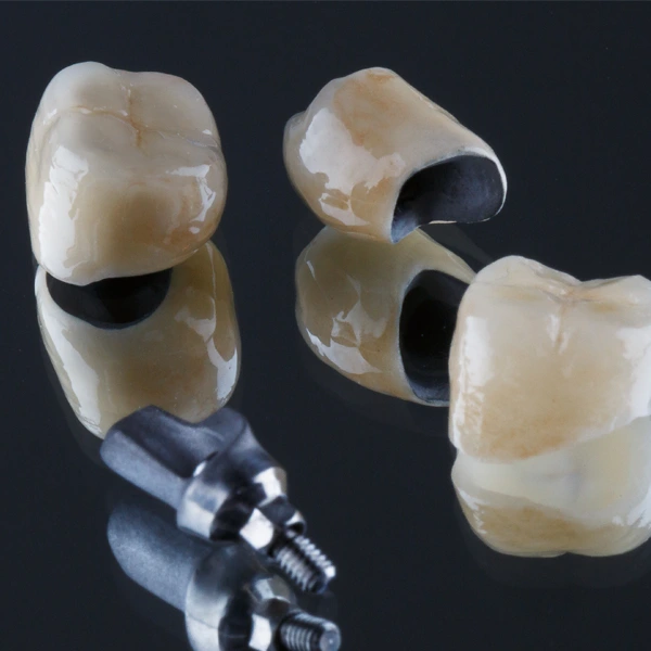 Porcelain Fused to Metal Crown