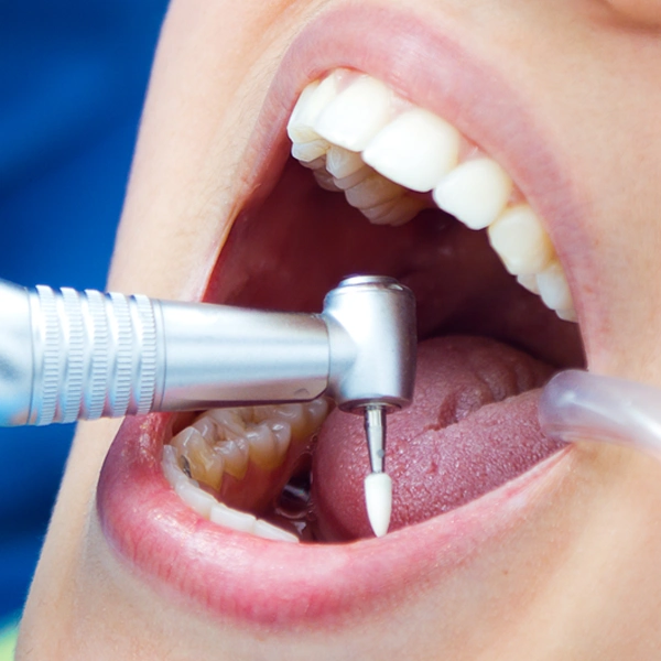 ขูดหินปูน