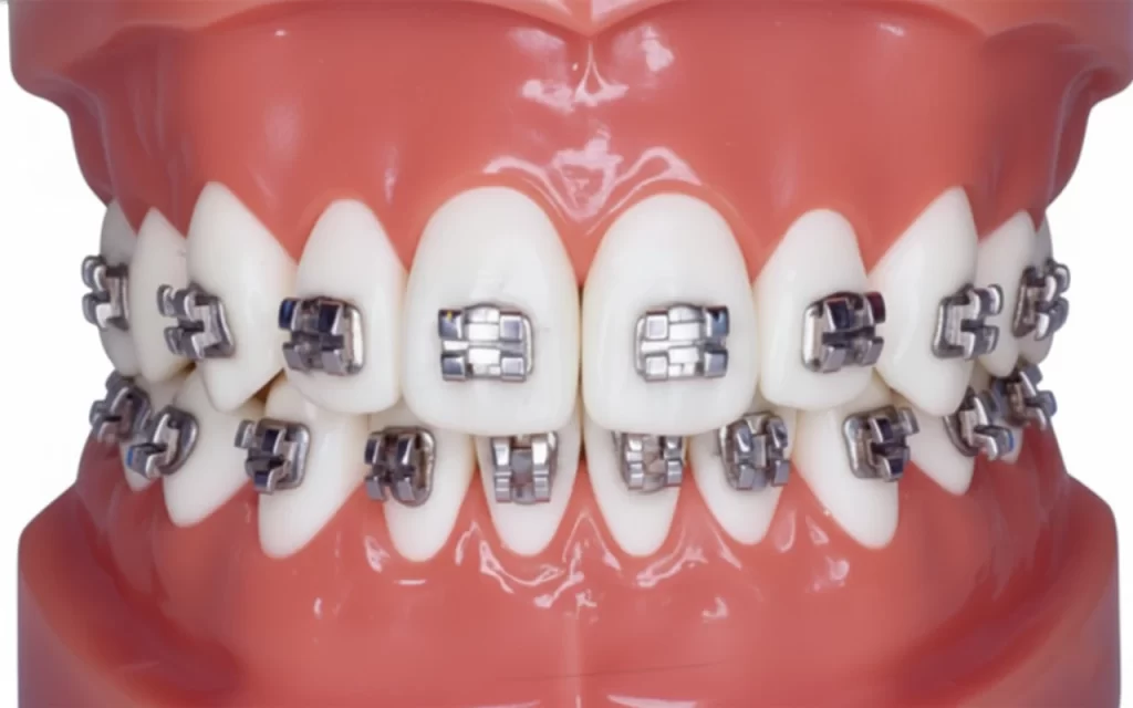 แบร็กเก็ต