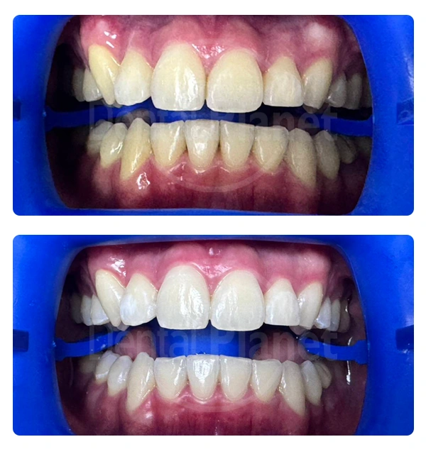 ฟอกฟันขาว