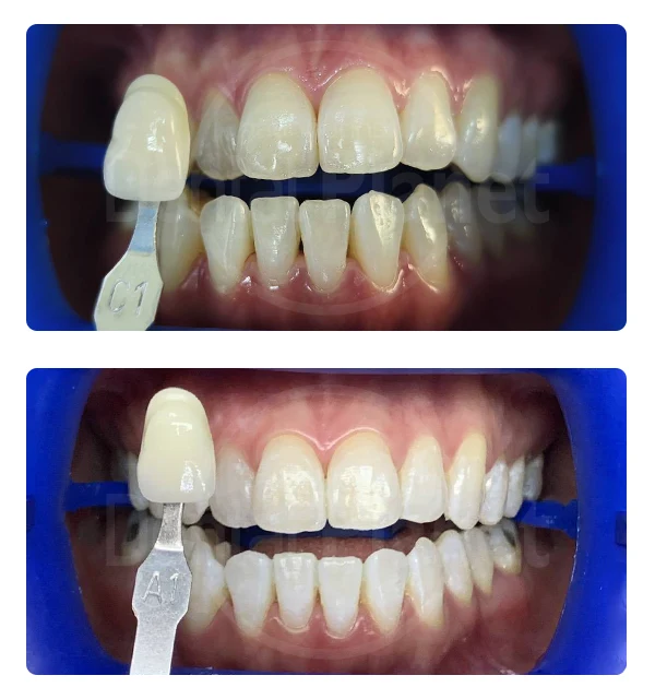 Before-After ฟอกสีฟันขาว (Cool Light Whitening)