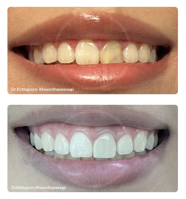 เคสรีวิวครอบฟัน ใกล้ฉัน