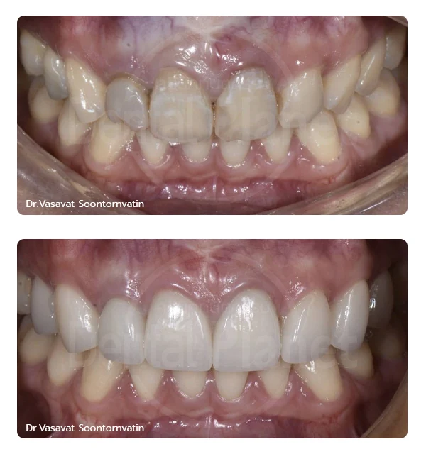 เคสรีวิววีเนียร์ Veneers