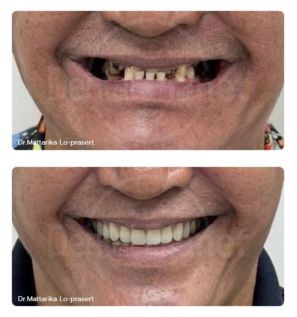 Before-After ฟันปลอมแบบทั้งปาก