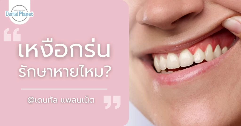 เหงือกร่น รักษาหายไหม
